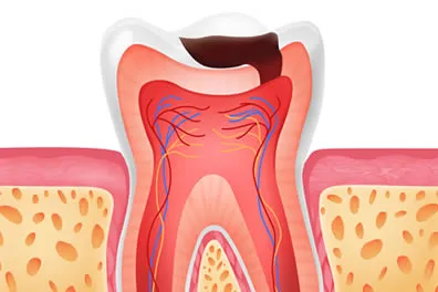 tooth cavity illustration